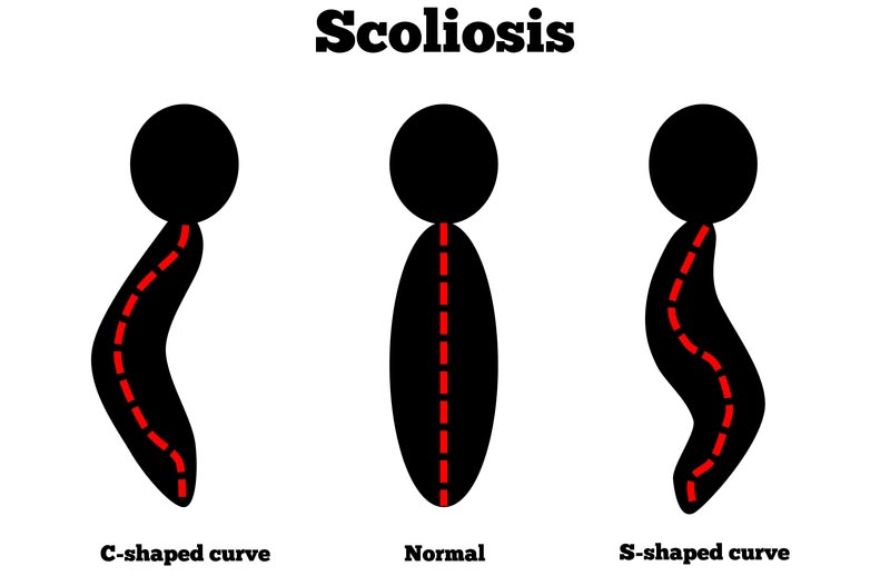 [City], [State] scoliosis treatment